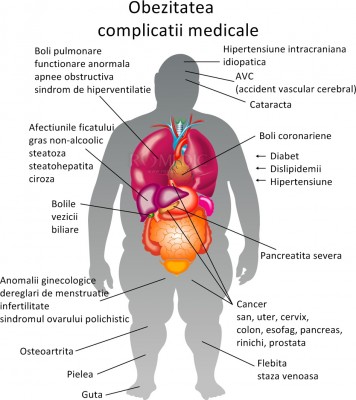 Cea mai bună pierdere în greutate pentru omul obez